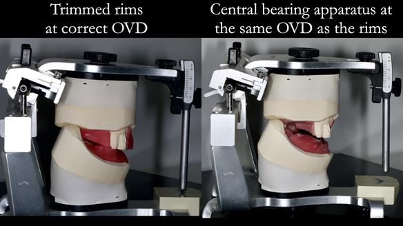Finlay's Newsletter 59 Ultra hard partial dentures made for Gill