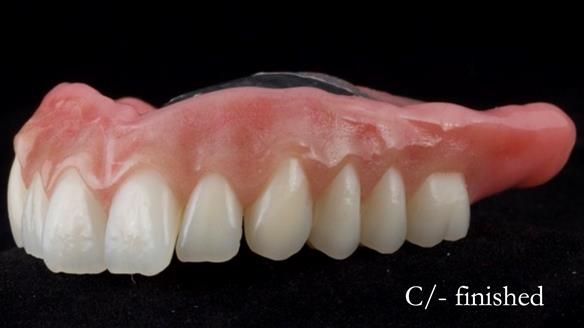 Managing poor implant positioning with complete dentures and Locator attachments - full protocol Newsletter 41