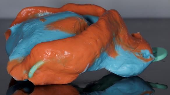 Newsletter 82 Mary - A complete upper and a one-tooth gasket denture