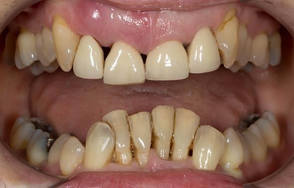 Figure 3 Overeruption of the upper and lower anterior segments with traumatic overbite and aesthetic failure