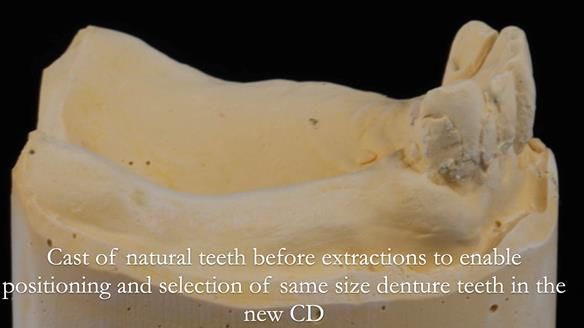 Finlay's Newsletter 62 provision of extractions and metal based complete dentures for Rafique