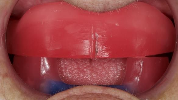 Newsletter 83: Sheila’s Complete Denture Success