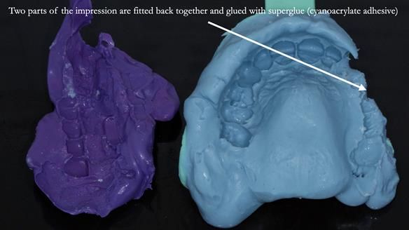 Newsletter 51 Managing Anne’s failing dentition with distal extension base RPD/Splint FULL PROTOCOL