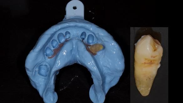 Newsletter 86 Peter the Architect — precision removable partial dentures case study