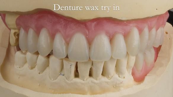 Newsletter 52 Managing Jo’s failing dentition with extractions and Mk 1/Mk 2 complete upper dentures and lower partial dentures FULL PROTOCOL