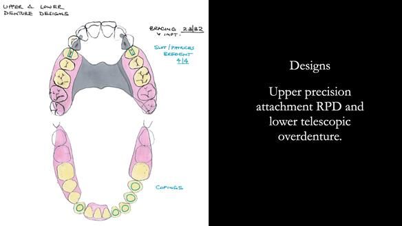Newsletter 76: Jackie’s case – Telescopic overdenture & precision RPD (the tricky truth!)