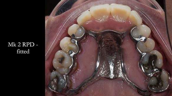 Finlay's Newsletter 63 Case study provision of metal based Scandinavian RPD - functional 10 years on