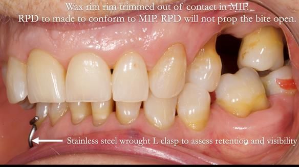 Finlay's Newsletter 61 provision of a lower unilateral free end saddle metal based partial denture for Joyce