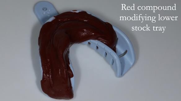 Finlay's Newsletter 59 Ultra hard partial dentures made for Gill