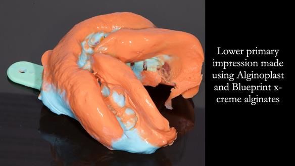 Newsletter 82 Mary - A complete upper and a one-tooth gasket denture