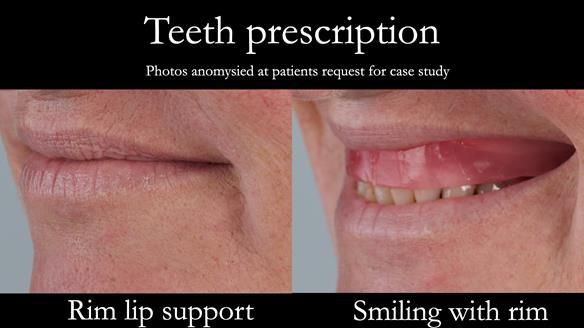 Newsletter 52 Managing Jo’s failing dentition with extractions and Mk 1/Mk 2 complete upper dentures and lower partial dentures FULL PROTOCOL