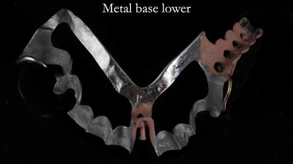 Newsletter 54 case presentation upper complete denture and lower Scandinavian designed hygienic partial denture for David