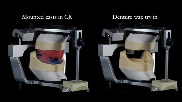 Newsletter 83: Sheila’s Complete Denture Success