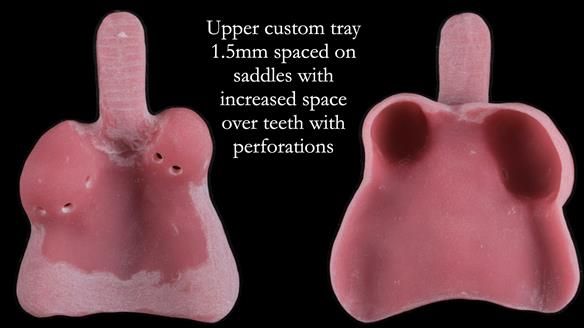 Finlay's Newsletter 59 Ultra hard partial dentures made for Gill