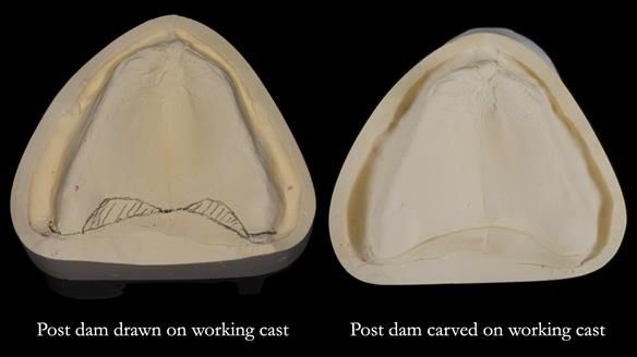 Newsletter 80 - Gordon’s dentures: the one case in 1,000 where my technique failed