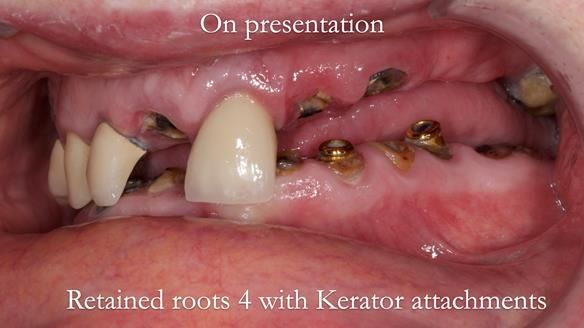Newsletter 44 - extreme removable prosthodontics – engineering a super-strong and ultra-thin over denture