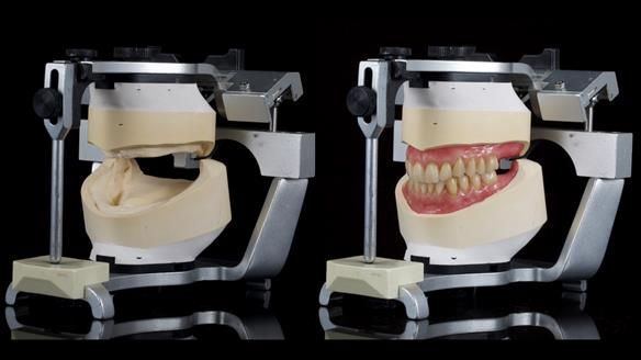 Newsletter 80 - Gordon’s dentures: the one case in 1,000 where my technique failed