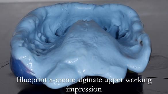 Finlay's Newsletter 64 case study - provision of a Kennedy class 2 metal based Scandinavian RPD for Ian