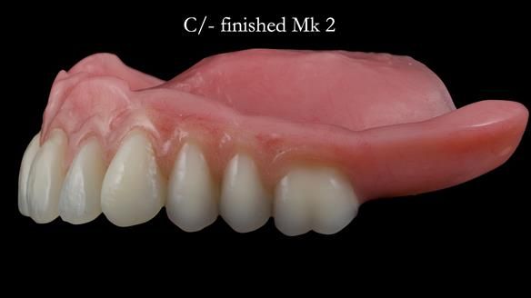 Newsletter 52 Managing Jo’s failing dentition with extractions and Mk 1/Mk 2 complete upper dentures and lower partial dentures FULL PROTOCOL