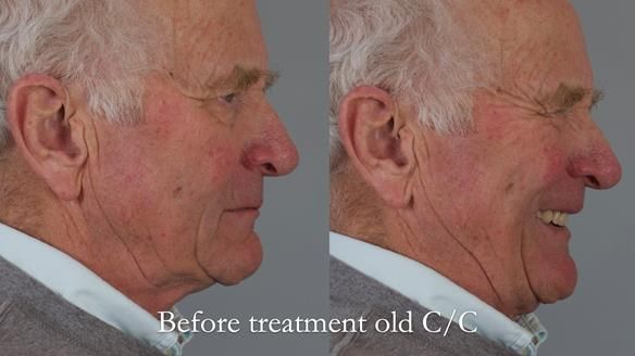 Complete denture Class II div 2 deep overbite Newsletter 39