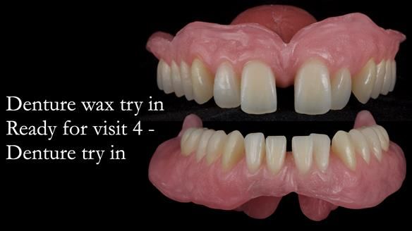 Newsletter 53 showing the making and fitting of ultra life-like dentures for Valena