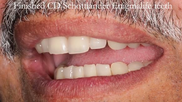 Finlay's Newsletter 62 provision of extractions and metal based complete dentures for Rafique