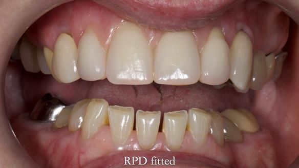 Newsletter 81 - Pam’s Story — how a partial denture changed her life (+ live walkthrough this Thursday)