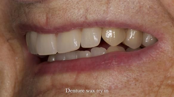 Newsletter 83: Sheila’s Complete Denture Success