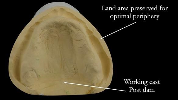 Post dam has been scored into the cast forming a posterior palate seal