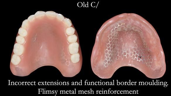 Newsletter 50 Special edition Complete Dentures FULL PROTOCOL