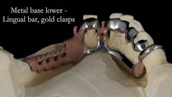 Newsletter 55 Provision of metal based partial dentures for Zephyrine with a repaired cleft lip and palate