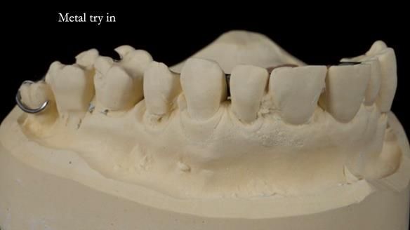 Finlay's Newsletter 64 case study - provision of a Kennedy class 2 metal based Scandinavian RPD for Ian