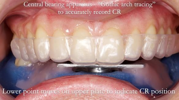 Newsletter 82 Mary - A complete upper and a one-tooth gasket denture