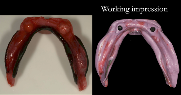 Figure 16 Lower working impression. Border moulded in greenstick followed by Impregum impression with full border moulding