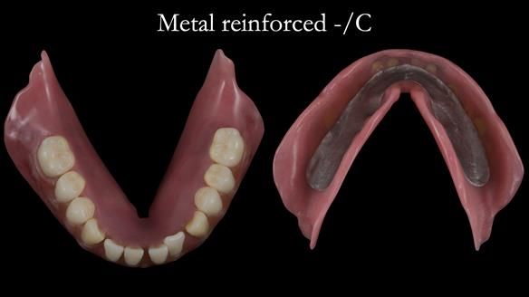 Newsletter 53 showing the making and fitting of ultra life-like dentures for Valena