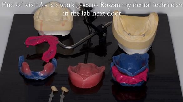 Newsletter 57 showcases the making and fitting process of implant-supported complete dentures for Alisdair