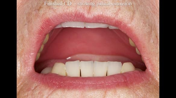 Newsletter 83: Sheila’s Complete Denture Success