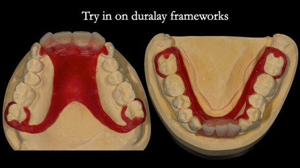 Figure 65 Teeth try in on pattern resin bases. These help to confirm the accuracy of the working casts and the amount of metal work which will be visible in the final dentures