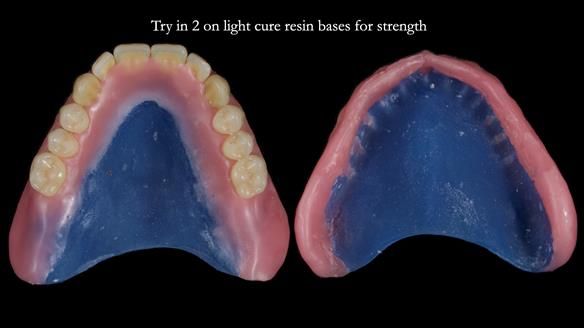 Newsletter 80 - Gordon’s dentures: the one case in 1,000 where my technique failed