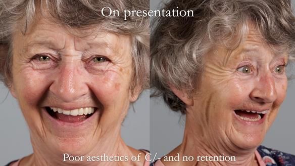 Solving Linda’s Failed “All on 4” implant bridges - full protocol Newsletter 42