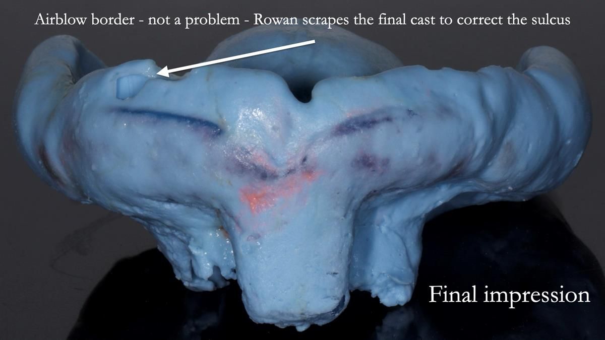 Fin’s Newsletter 88 — Complete dentures - full protocol… he rearranged his own teeth!