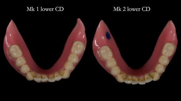 Newsletter 83: Sheila’s Complete Denture Success