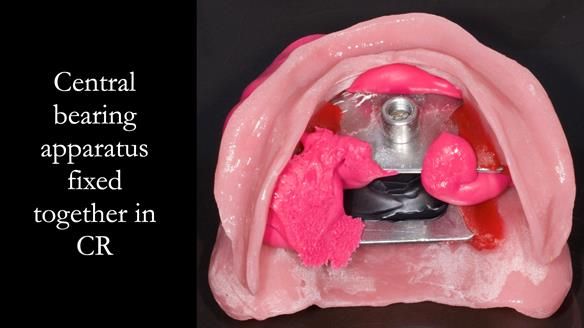 Complete denture Class II div 2 deep overbite Newsletter 39