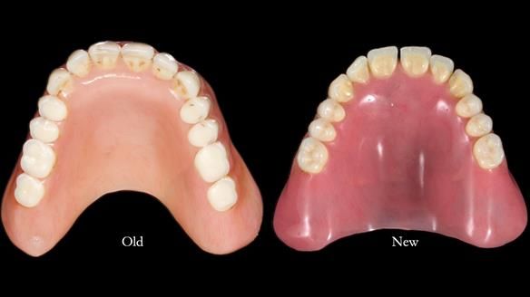 Newsletter 78: What do Clark Gable and a Locator® overdenture have in common?