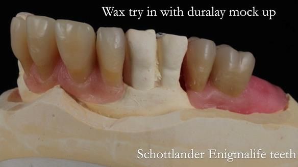 Finlay's Newsletter 59 Ultra hard partial dentures made for Gill