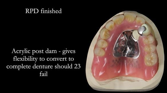 Newsletter 55 Provision of metal based partial dentures for Zephyrine with a repaired cleft lip and palate