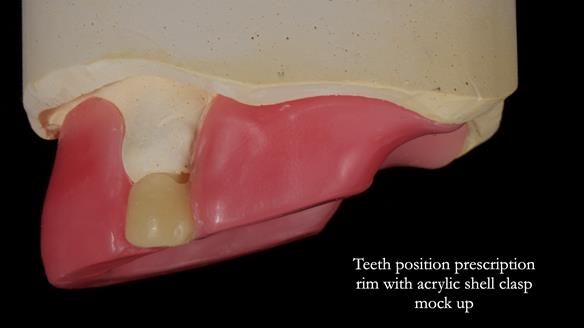 Newsletter 55 Provision of metal based partial dentures for Zephyrine with a repaired cleft lip and palate