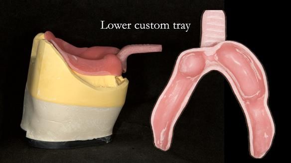 Newsletter 76: Jackie’s case – Telescopic overdenture & precision RPD (the tricky truth!)