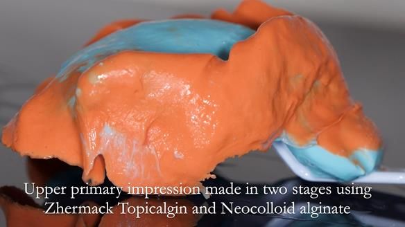 Managing poor implant positioning with complete dentures and Locator attachments - full protocol Newsletter 41