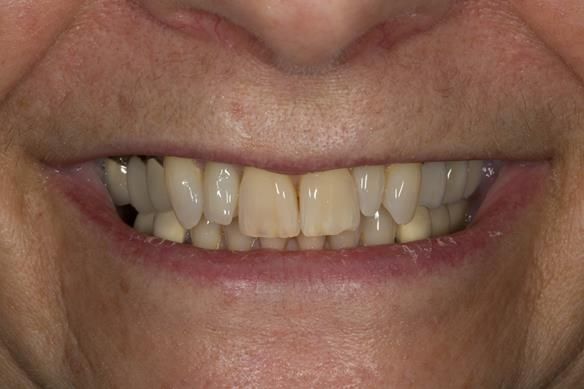 Figure 2 Pre - treatment.